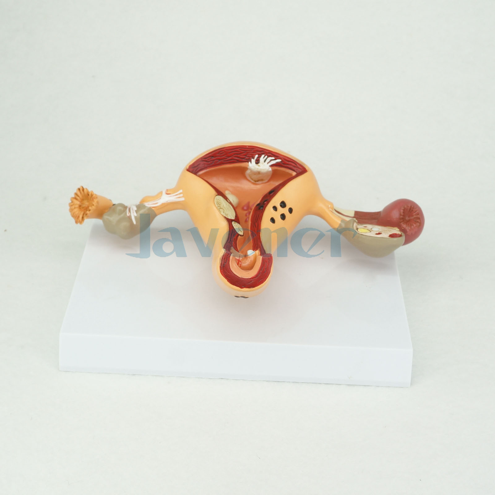 Pathological Uterus and Ovary Anatomical Model Human Female Medical